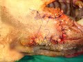 CARCINOMA DE CELULAS ESCAMOSAS CARCINOMA DE CELULAS ESCAMOSAS