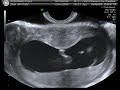 Baby McDee