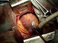 CARDIAC SURGERY