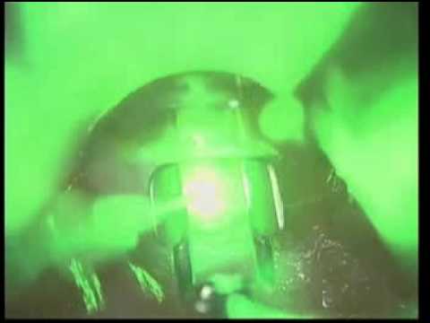 how to treat zenker's diverticulum