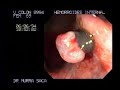 Rubber bands treatment for internal Hemorrhoids Rubber bands treatment for internal Hemorrhoids