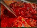 donor hepatectomy donor hepatectomy