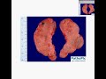 Histopathology Thyroid--Hashimoto thyroiditis