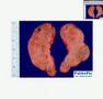 Histopathology Thyroid--Hashimoto thyroiditis