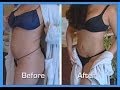 Abdomen and Waist- Smartlipo-Tumescent Liposuction