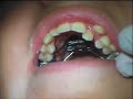 dr. christopher maulik, of scripps poway orthodontics, demonstrates the insertion of a rapid palatal expander (rpe).  used for orthodontics, to widen the upper jaw.