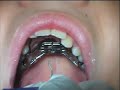 dr. christopher maulik, of scripps poway orthodontics, demonstrates the insertion of a rapid palatal expander (rpe).  used for orthodontics, to widen the upper jaw.