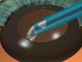 Cataract Surgery 3D: Oliver Findl, MD