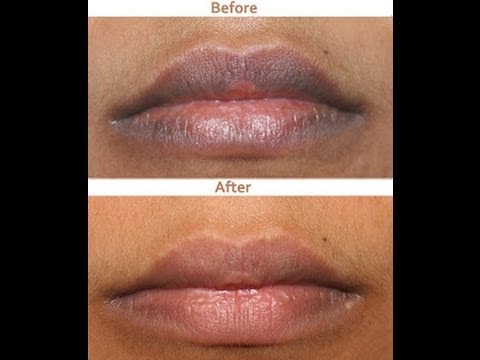 how to whiten dark lips