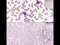 Histopathology Blood --Acute leukemia Histopathology Blood --Acute leukemia