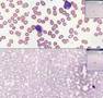 Histopathology Blood --Acute leukemia