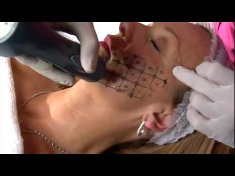 Il Thermage