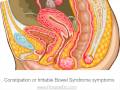 Symptoms of Fibriods