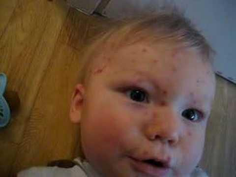 Chicken pox, poor baby!