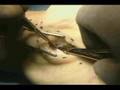 Carpal Tunnel Surgery
