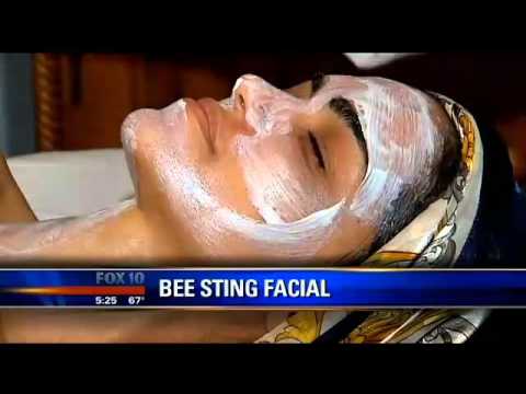 how to treat bee stings nz