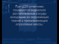 Нажмите для просмотра : Метастазирующий рак молочной железы