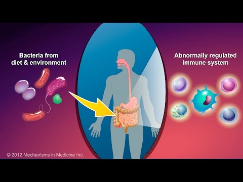 how to cure ischemic colitis