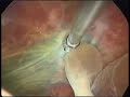 HUMAN EMBRYOSCOPY II. MEDIFERTIL: BOGOTA - COLOMBIA.