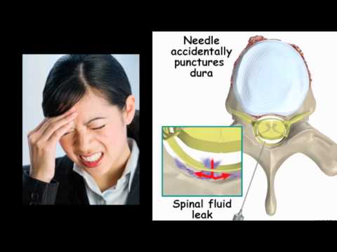 how to perform epidural blood patch