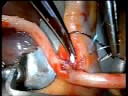 beating heart surgery Radial to PDA