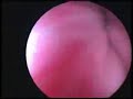 Botox Overview