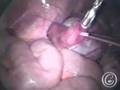 ART 2: GIFT/ZIFT (Infertility Treatment)
