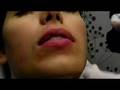 Lip Augmentation
