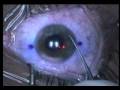 My Lasik Surgery My Lasik Surgery