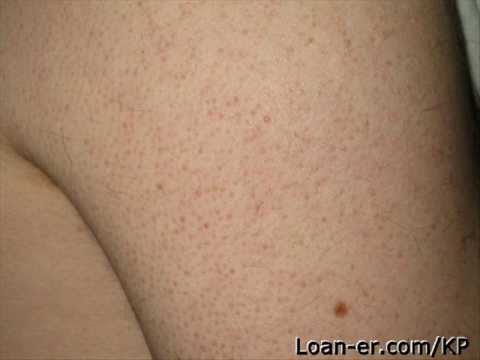 how to get rid keratosis pilaris on legs