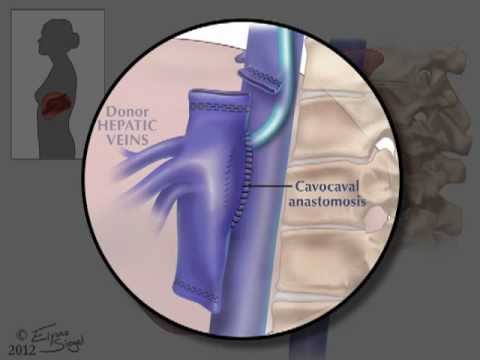 hepatic biopsy -