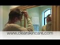 Hair restoration with derma skin roller Hair restoration with derma skin roller