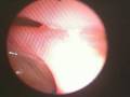 Bilateral Sinusitis and Midmeatal Polyps