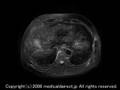 今日のEOBプリモビストMRI EOB Primovist of the Day.