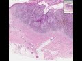 Pathology - Malignant melanoma