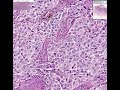 Histopathology Skin --Malignant melanom