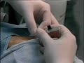 Arterial Line Insertion