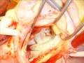 Mitral stenosis and left atrial thrombus僧帽瓣狹窄手術-嘉義長庚心臟外科