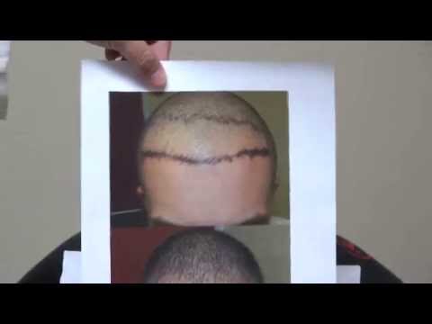 how to sleep after fue hair transplant