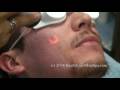 Active FX Laser Acne Scars Removal