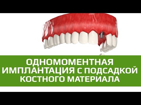 Имплантация зубов подсадка Имплантация зубов подсадка