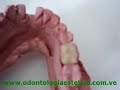 Incrustaci�n de Resina