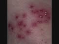 MRSA