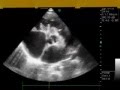 Atrioventricular Canal In Echocardiography Examination Atrioventricular Canal In Echocardiography Examination