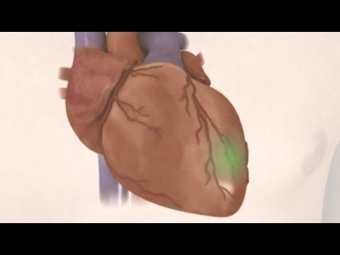 how to avoid heart disease