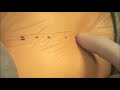 Ventricular Septal Defect (VSD) Surgical Repair