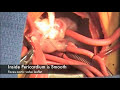 Ventricular Septal Defect (VSD) Surgical Repair - Pediatric Heart Surgery Ventricular Septal Defect (VSD) Surgical Repair - Pediatric Heart Surgery
