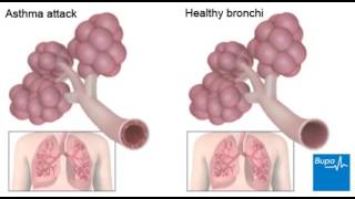 How an asthma attack occurs