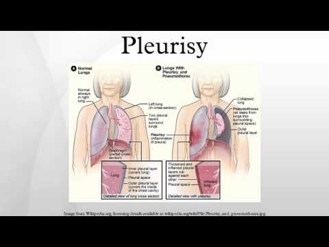 how to relieve pleurisy