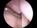 Rotator cuff surgery Rotator cuff surgery
